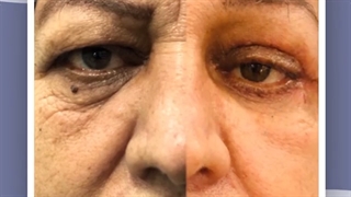 فیلم جراحی همزمان پلک بالا و پایین