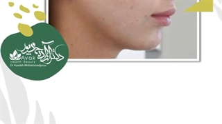 موضوع: فیلر زاویه دهی فک