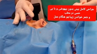 جراحی بینی با بی حسی و بدون بیهوشی