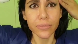 فیلم عمل لیفت شقیقه و ابرو، مینی لیفت، سانترال و غبغب