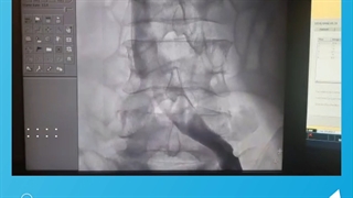 تعبیه فیلتر ورید اجوف تحتانی در بیمار مبتلا به کرونا