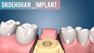 دکتر وحید دهقان متخصص جراحی فک و صورت : فرآیند ایمپلنت چگونه انجام می شود؟