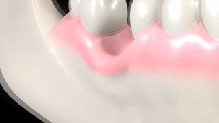 پیوند استخوان : دکتر وحید دهقان متخصص جراحی فک و صورت