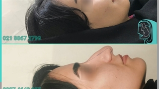 انجام جراحی زیبایی بینی برای زیباجو عزیز توسط دکتر پژمان سرشارزاده