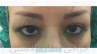 فیلم واقعی جراحی بلفارو پلاستی پلک