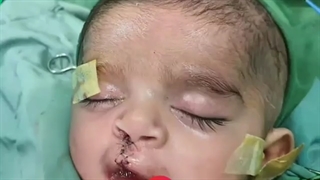 عمل جراحی شکاف لب