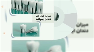 طول عمر ایمپلنت دندان چقدر است؟