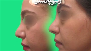 ژنیوپلاستی