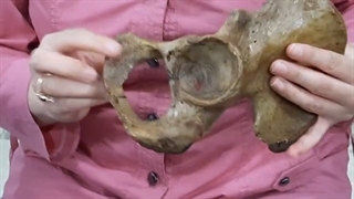 استخوان هیپ3. پزشکی. عملی