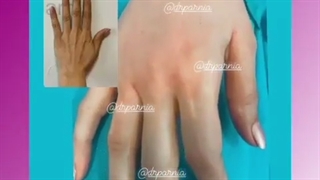 تزریق چربی دست