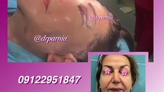 لیفت کامل صورت و گردن