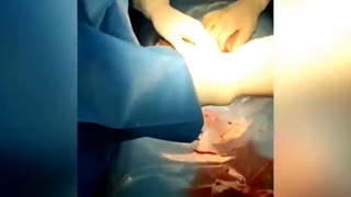 فیلم زایمان سزارین اتاق عمل