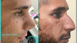 انجام جراحی زیبایی بینی استخوانی برای زیباجو عزیز توسط دکتر پژمان سرشارزاده