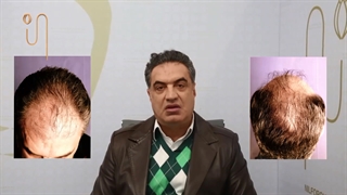 تجربه کاشت مو در کلینیک دکتر نیلفروش زاده
