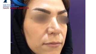 نتیجه تزریق ژل لب و خط خنده توسط دکتر آزیتا مولازاده