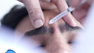 تزریق بوتاکس در خطوط پیشانی