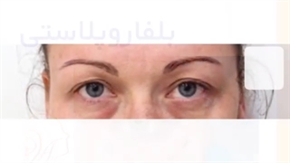 فیلم واقعی در اتاق عمل جراحی بلفاروپلاستی