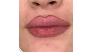 نمونه تزریق ژل به لب