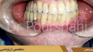 چه کنیم دندان ها بعد از جرمگیری حساس نشوند؟