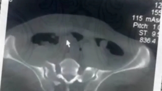 شکستگی حلقه لگنی