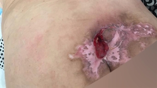 درمان زخم بستر با پودر کلاژن