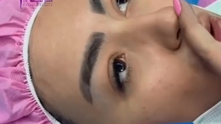 جراحی بینی با فرم فانتزی