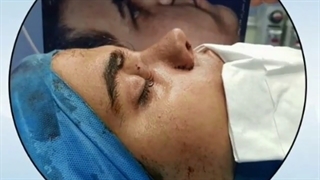 فیلم جراحی زیبایی بینی