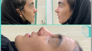 انجام جراحی نیمه فانتزی بینی برای زیباجو عزیز توسط دکتر پژمان سرشارزاده