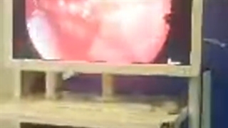 فیلم کامل و واقعی آندوسکوپی سینوس