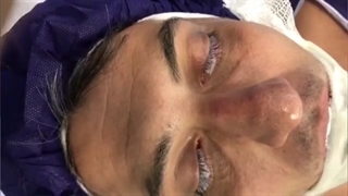 فیلم کامل و بدون سانسور عمل زیبایی بینی