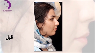 جراحی بینی در اهواز توسط دکتر محمدعلی حسینی