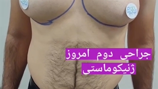فیلم عمل جراحی ژنیکوماستی - الو جراح