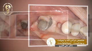 کاشت ایمپلنت بدون بخیه و خونریزی