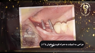 جراحی سه ایمپلنت به صورت همزمان