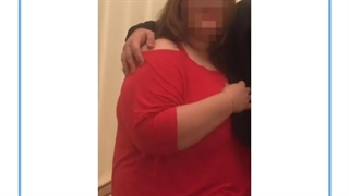 تصاویر قبل و بعد از عمل چاقی