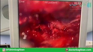 کیست سینوویال ستون فقرات