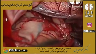 آنوریسم شریان مغزی میانی