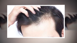 عوامل ریزش مو