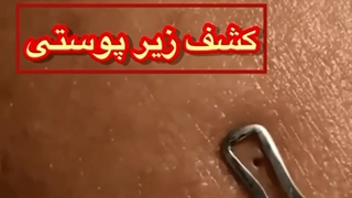 کشف زیر پوستی