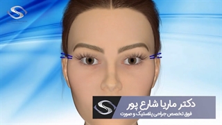 عوارض چشم گربه ای!