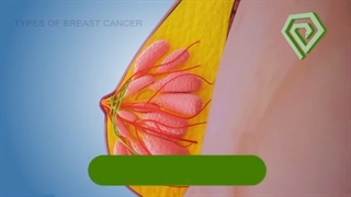 فیلم تشخیص سرطان پستان در مراحل اولیه