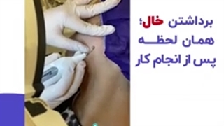برداشتن خال
