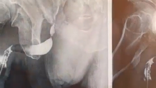 فیلم درمان تنگی مجاری ادرار