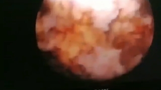 تومور مثانه