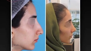 فرم بینی بعد از جراحی فانتزی