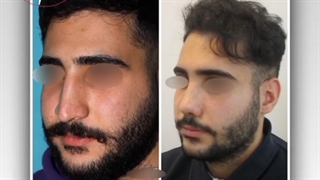 فرم بینی بعد از عمل نچرال