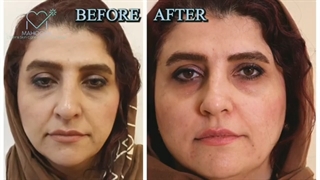 تزریق ژل خط خنده و جوانسازی لب طبیعی
