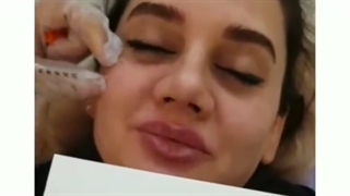 جوانسازی صورت با مزوژل جالپرو کلینیک پوست