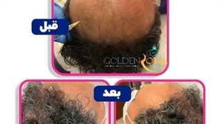 پی آر پی مو