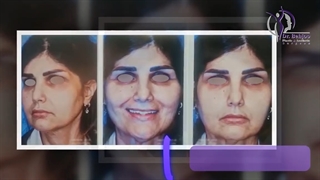 فیلم واقعی لیفت اندوسکوپی پیشانی و صورت و جراحی زیبایی بینی